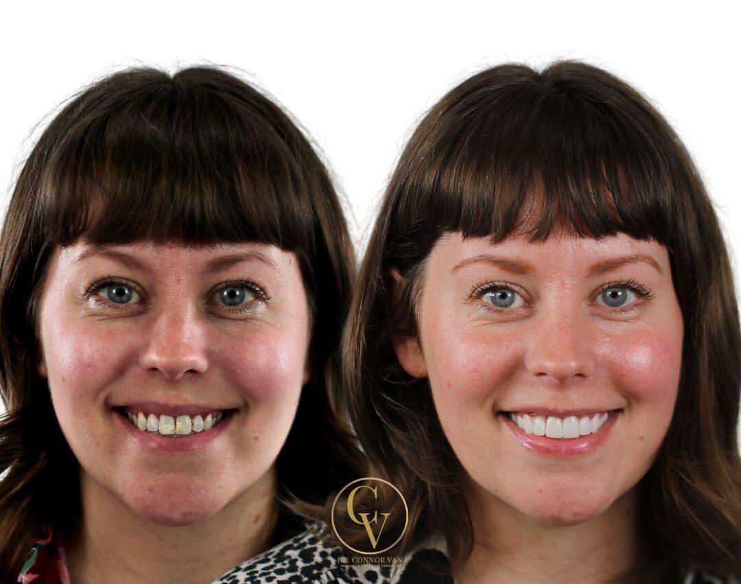 Central Florida Dental Implants before and after 10