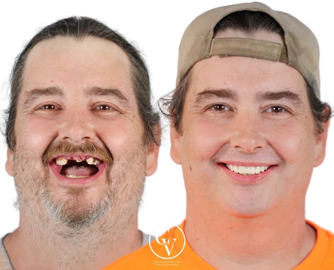 Central Florida Dental Implants before and after 12