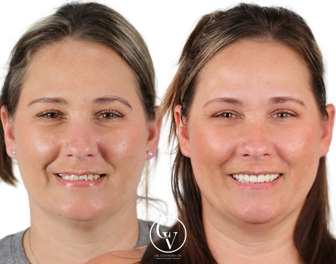 Central Florida Dental Implants before and after 13