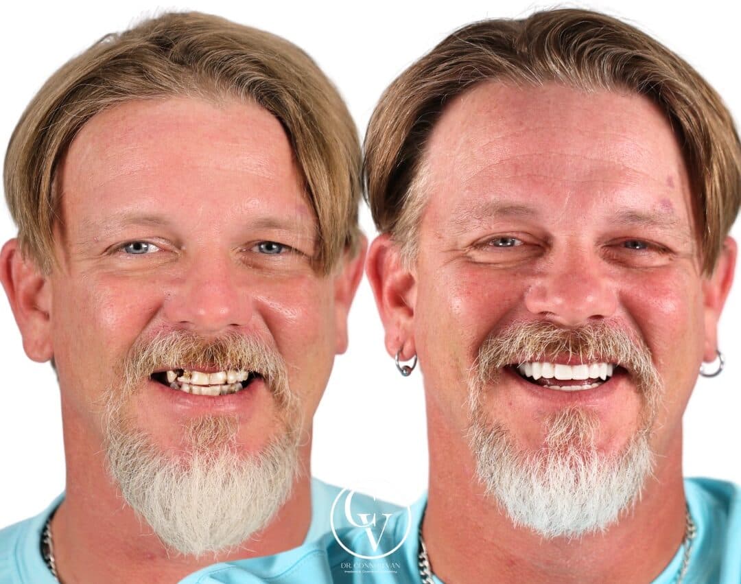 Central Florida Dental Implants before and after 14