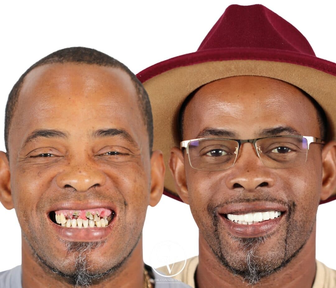 Central Florida Dental Implants before and after 15