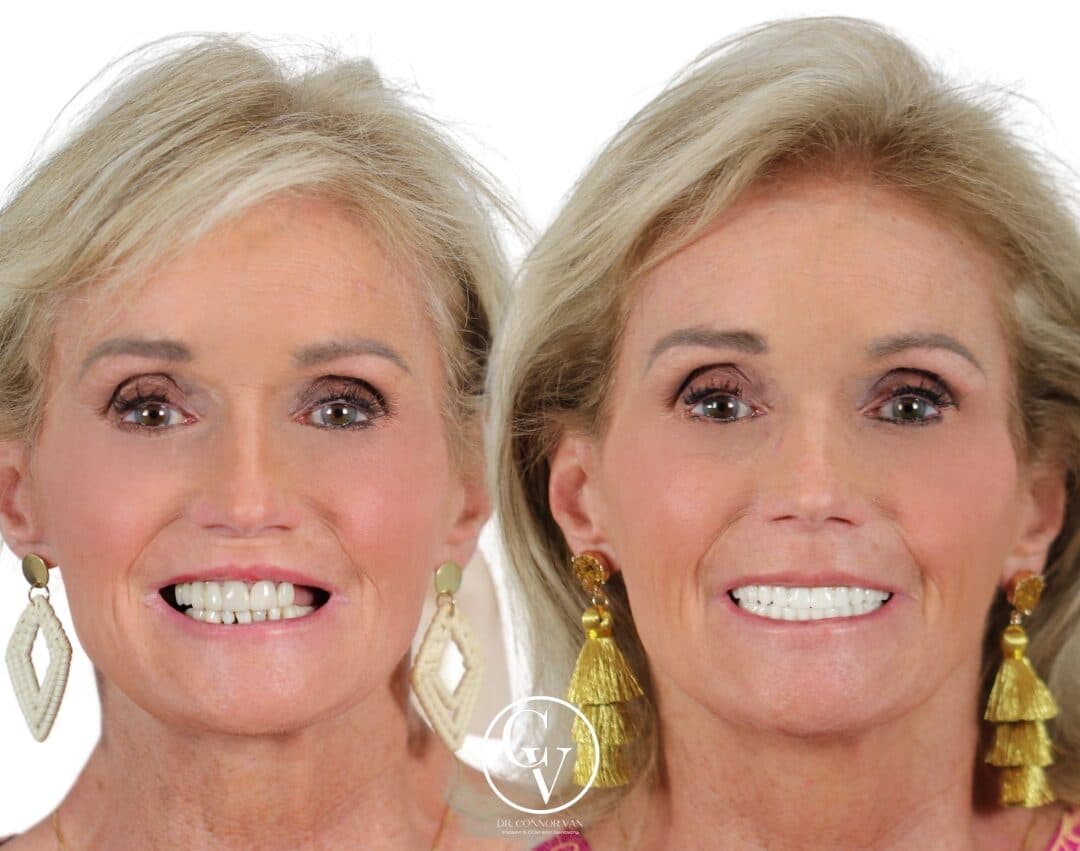 Central Florida Dental Implants before and after 16