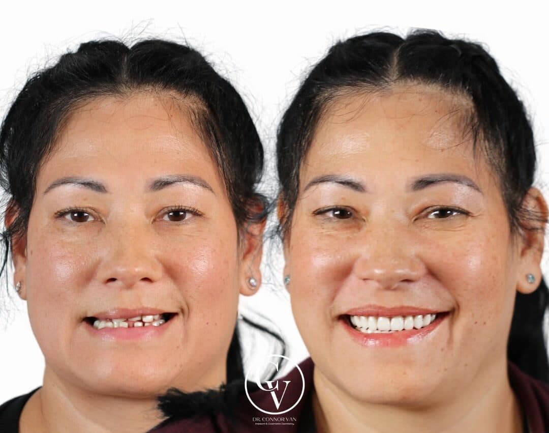 Central Florida Dental Implants before and after 17