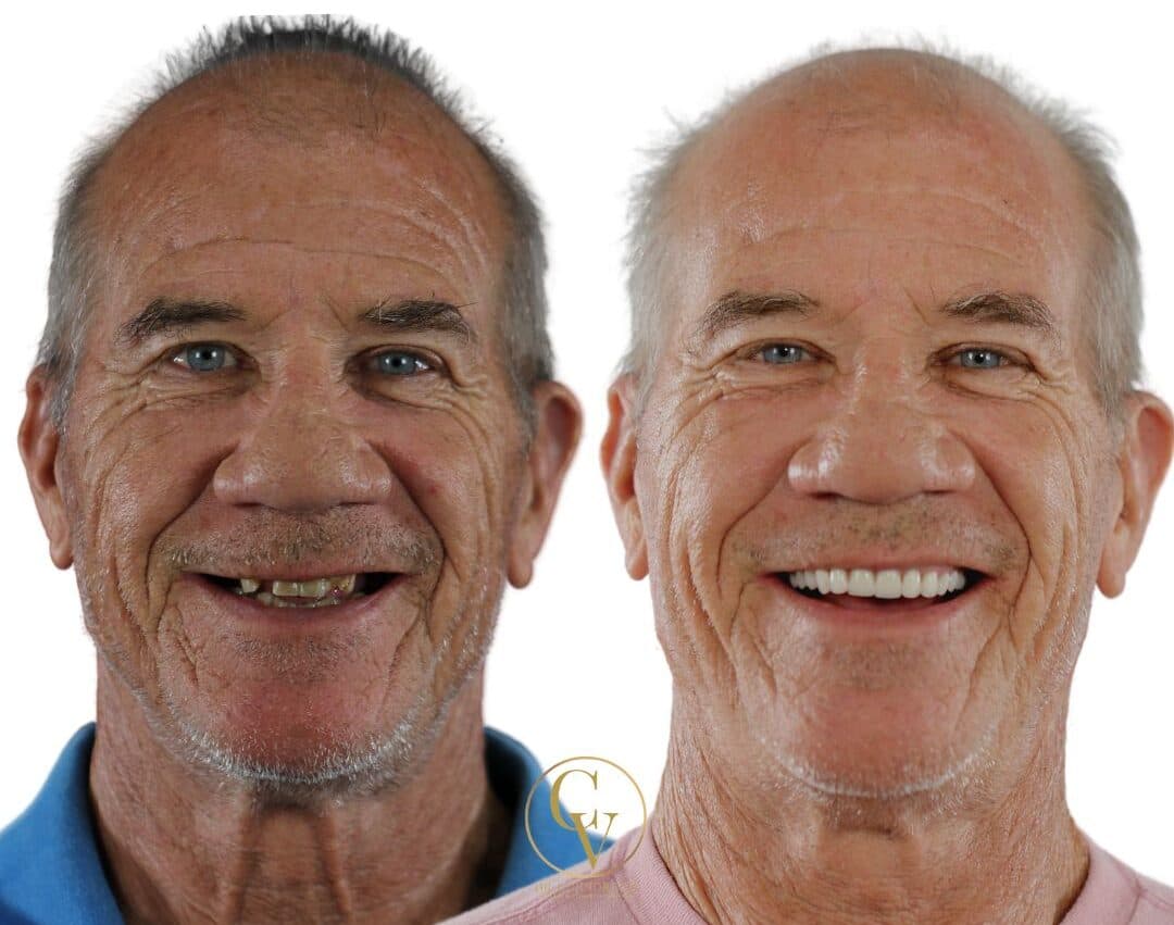 Central Florida Dental Implants before and after 6