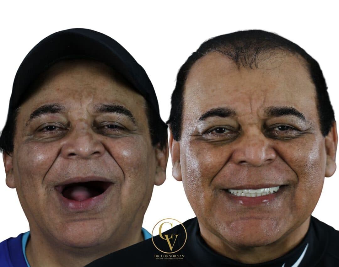 Central Florida Dental Implants before and after 8