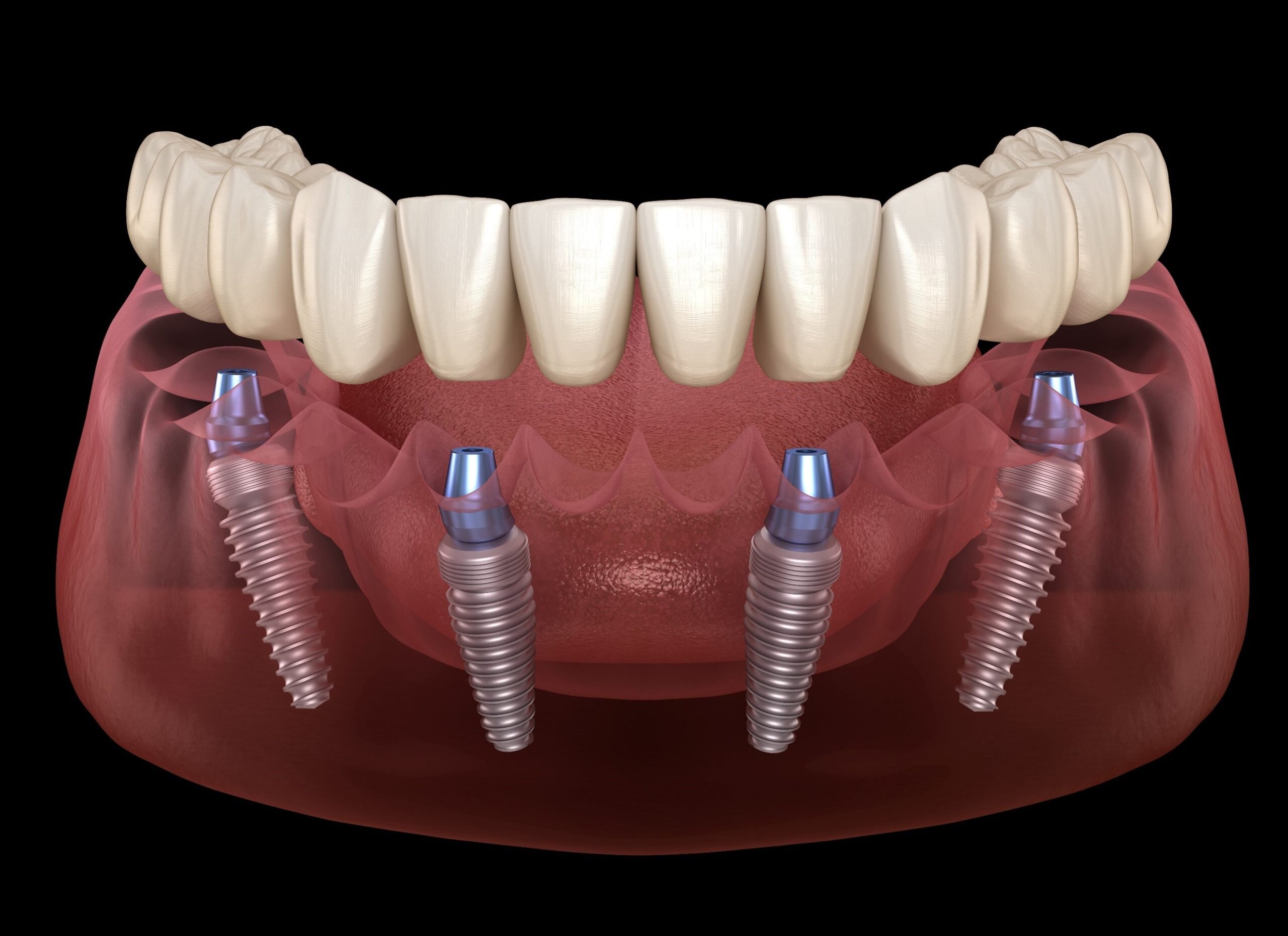 All-on-4 dental implants
