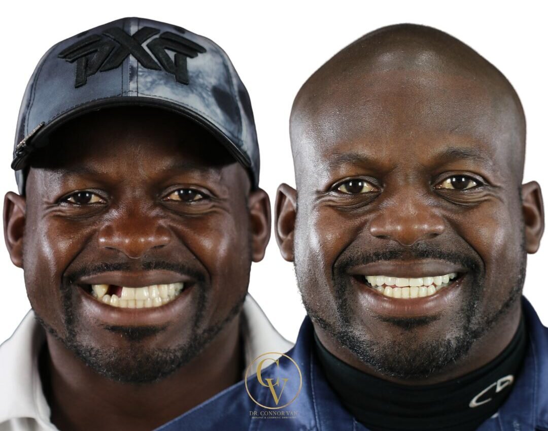 Central Florida Dental Implants before and after 11