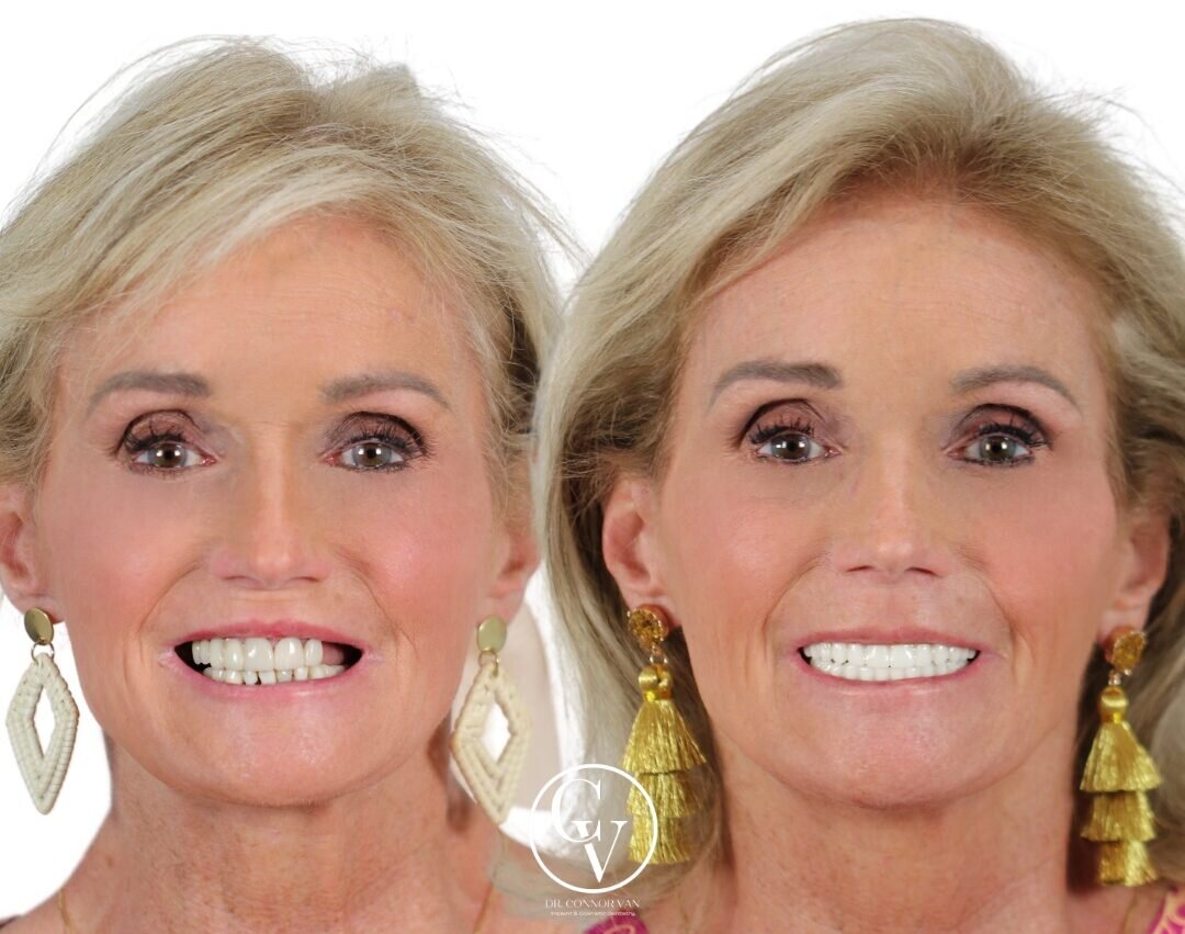 Central Florida Dental Implants before and after 16