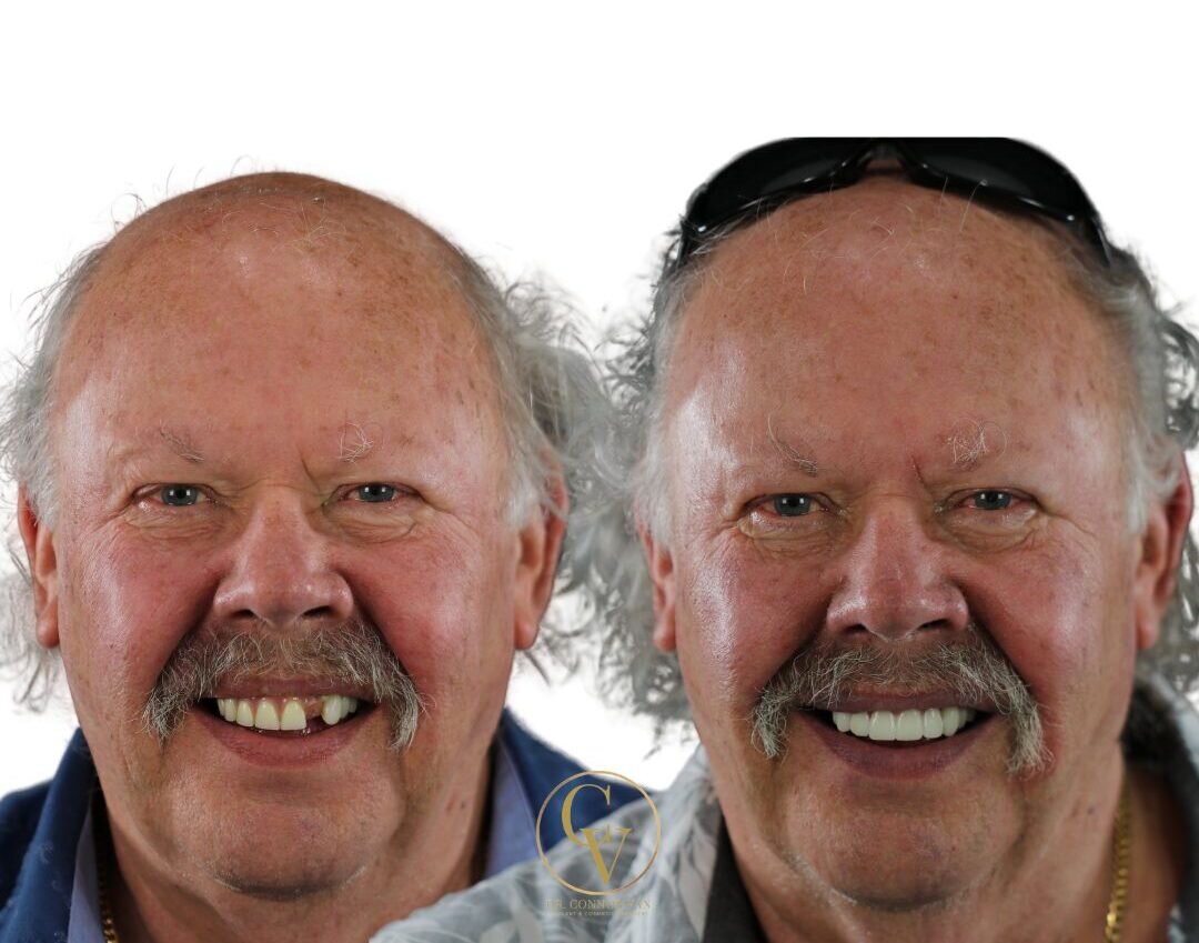 Central Florida Dental Implants before and after 7