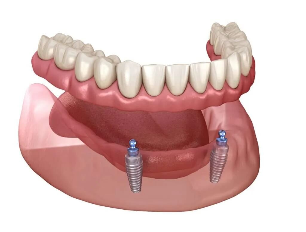 Implant supported dentures
